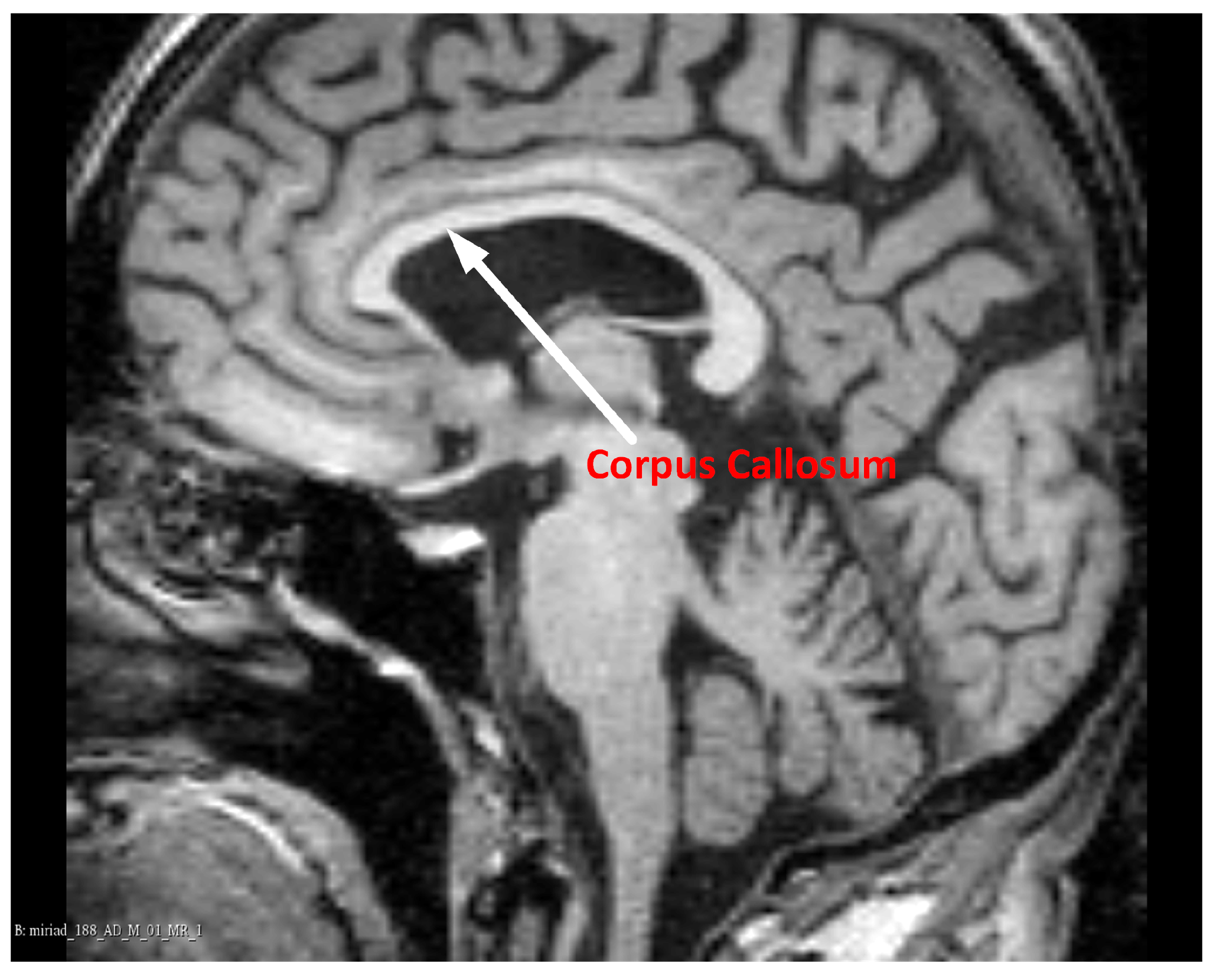 Symmetry Free FullText SemiAutomatic Corpus Callosum Segmentation