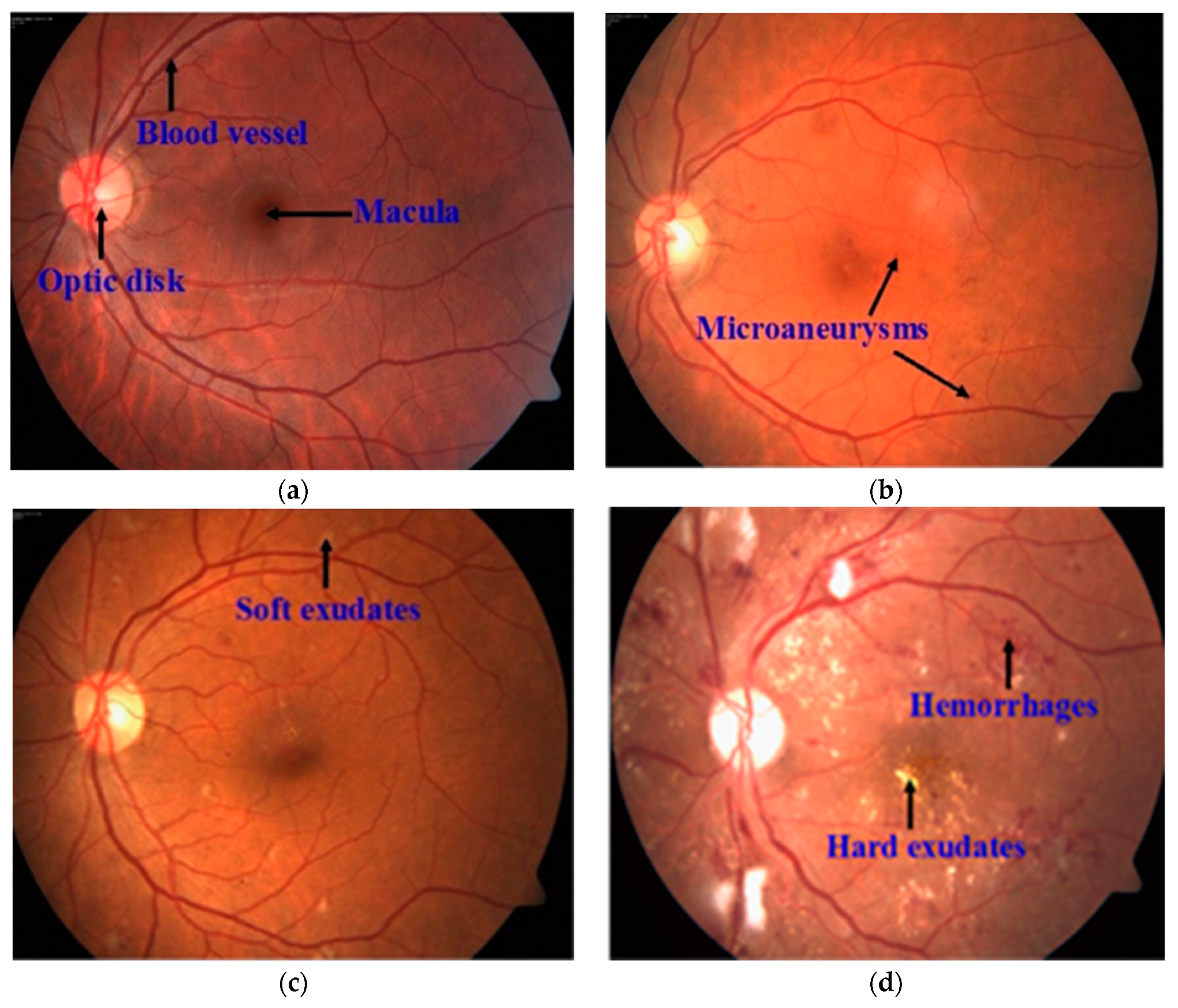 diabetic retinopathy diagnosis)