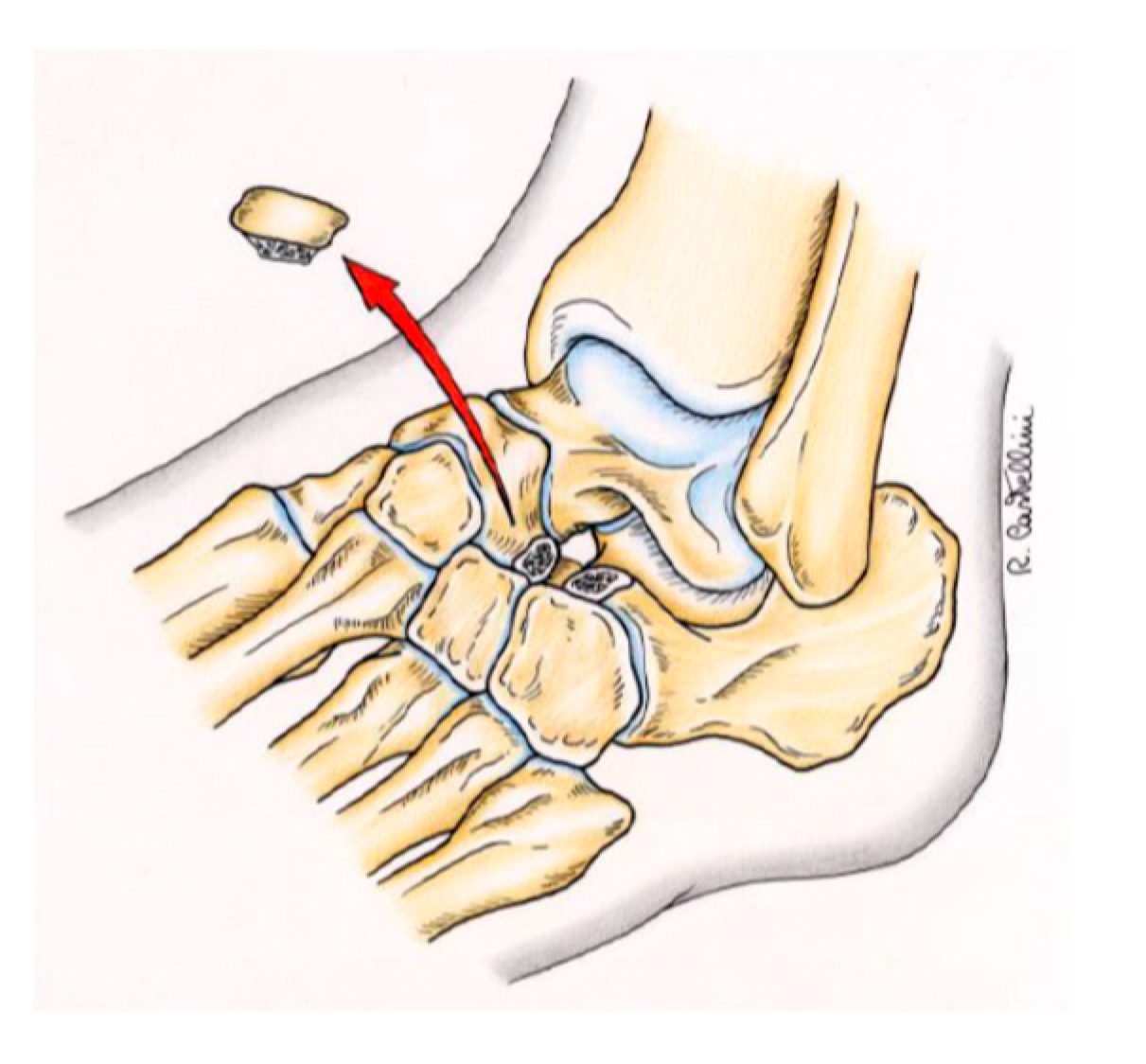 Symmetry Free Full Text Paediatric Orthopaedic Surgery With 3d Printing Improvements And Cost Reduction Html