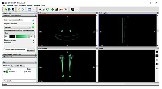 Symmetry Free Full Text Paediatric Orthopaedic Surgery With 3d Printing Improvements And Cost Reduction Html