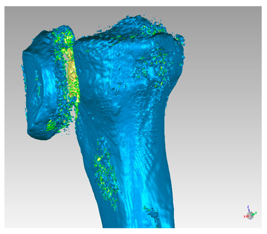 Symmetry Free Full Text Paediatric Orthopaedic Surgery With 3d Printing Improvements And Cost Reduction Html