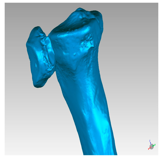 Symmetry Free Full Text Paediatric Orthopaedic Surgery With 3d Printing Improvements And Cost Reduction Html