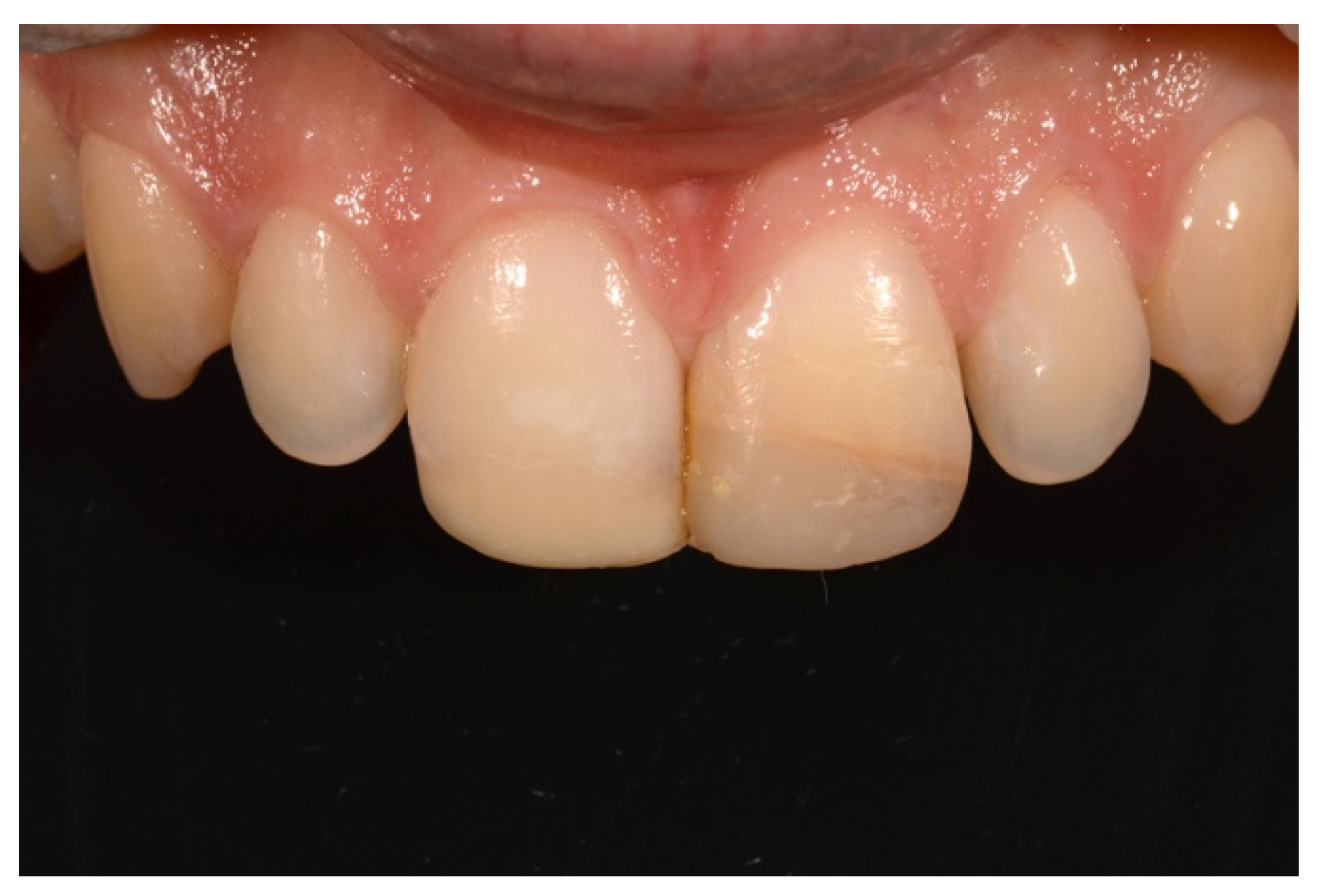Symmetry Free FullText Direct Esthetic Composite Restorations in