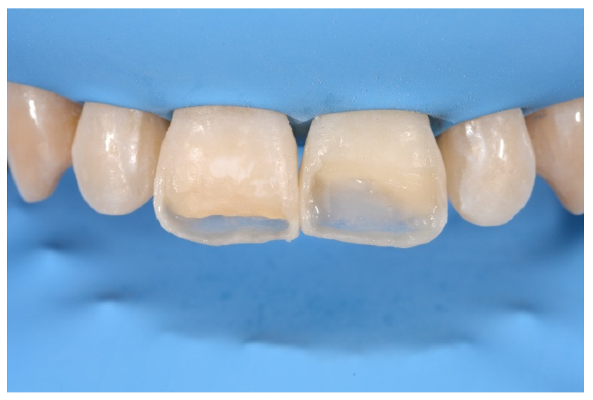 Symmetry Free FullText Direct Esthetic Composite Restorations in
