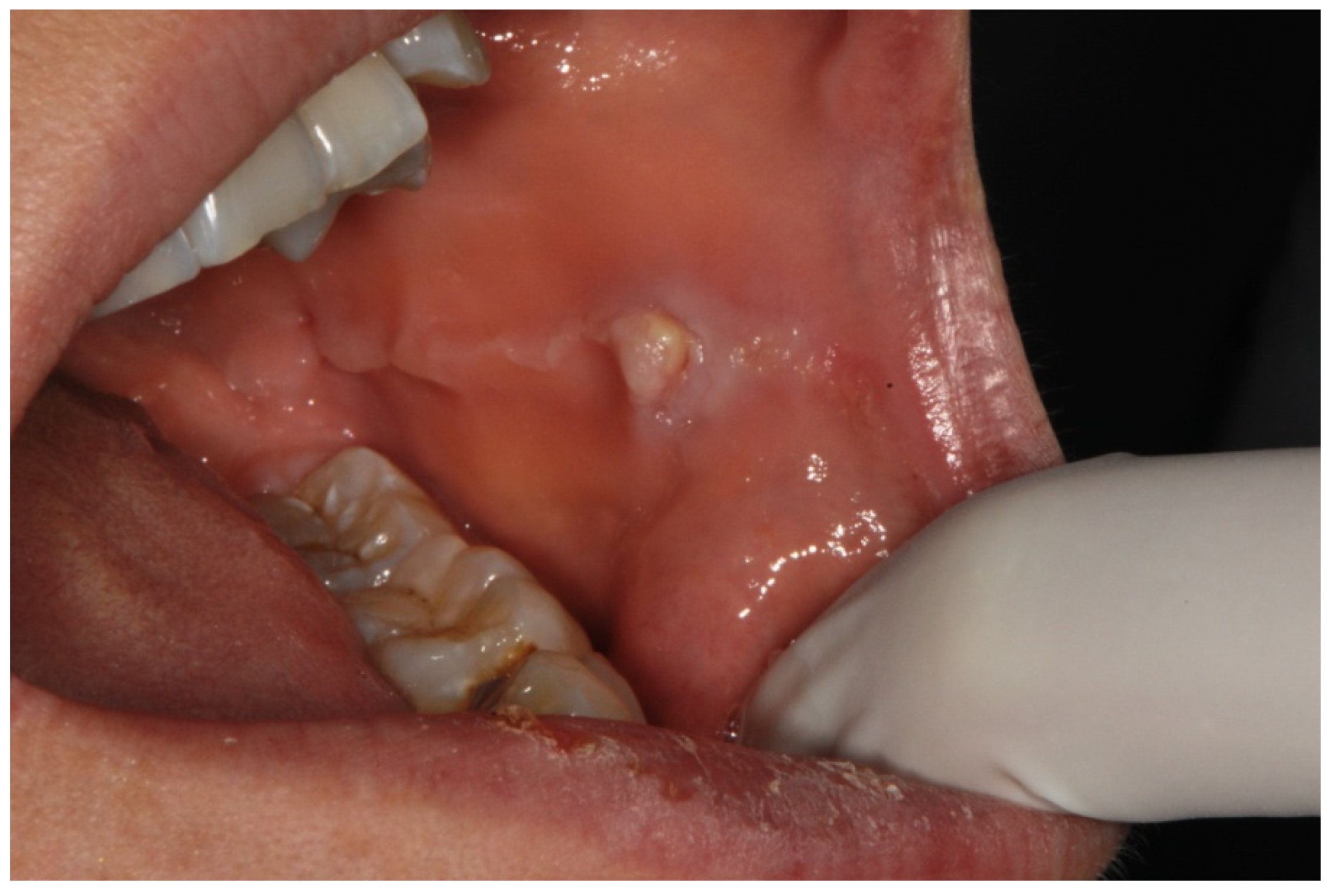 Symmetry | Free Full-Text | Prevalence and Characteristic of Oral Mucosa  Lesions