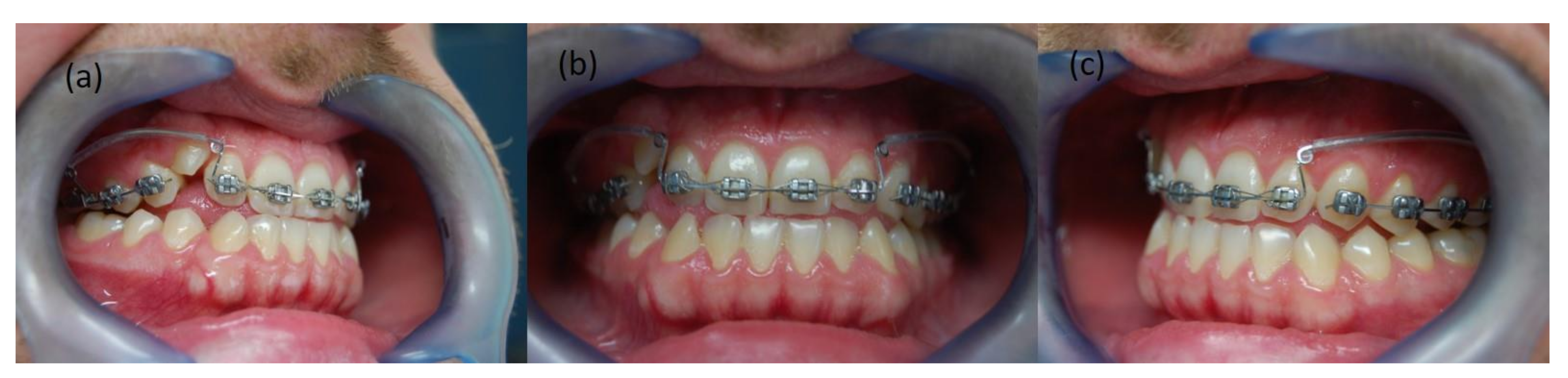 Symmetry Free Full Text The Practitioner Rsquo S Eye The Ricketts Technique Elements In Non Extraction Treatment Camouflaging Skeletal Class Iii With Bite Asymmetry Mdash A Case Series Presentation Html Symmetry Free Full Text The Practitioner Rsquo S Eye The Ricketts Technique Elements In Non Extraction Treatment Camouflaging Skeletal Class Iii With Bite Asymmetry Mdash A Case Series Presentation Html