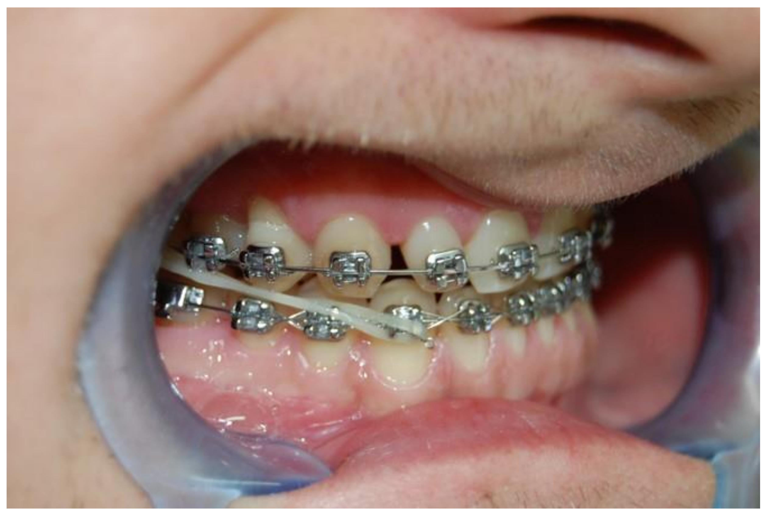 Symmetry Free Full Text The Practitioner Rsquo S Eye The Ricketts Technique Elements In Non Extraction Treatment Camouflaging Skeletal Class Iii With Bite Asymmetry Mdash A Case Series Presentation Html Symmetry Free Full Text The Practitioner Rsquo S Eye The Ricketts Technique Elements In Non Extraction Treatment Camouflaging Skeletal Class Iii With Bite Asymmetry Mdash A Case Series Presentation Html