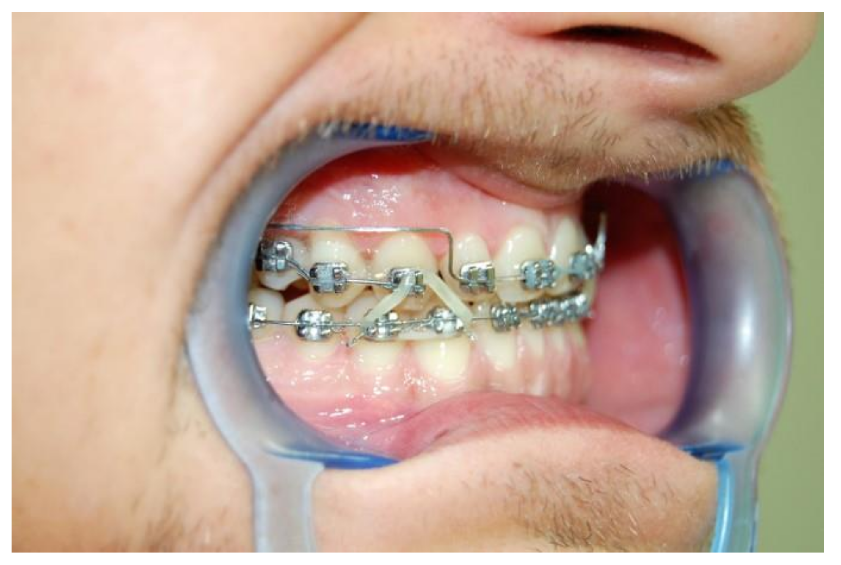 Symmetry Free Full Text The Practitioner Rsquo S Eye The Ricketts Technique Elements In Non Extraction Treatment Camouflaging Skeletal Class Iii With Bite Asymmetry Mdash A Case Series Presentation Html Symmetry Free Full Text The Practitioner Rsquo S Eye The Ricketts Technique Elements In Non Extraction Treatment Camouflaging Skeletal Class Iii With Bite Asymmetry Mdash A Case Series Presentation Html