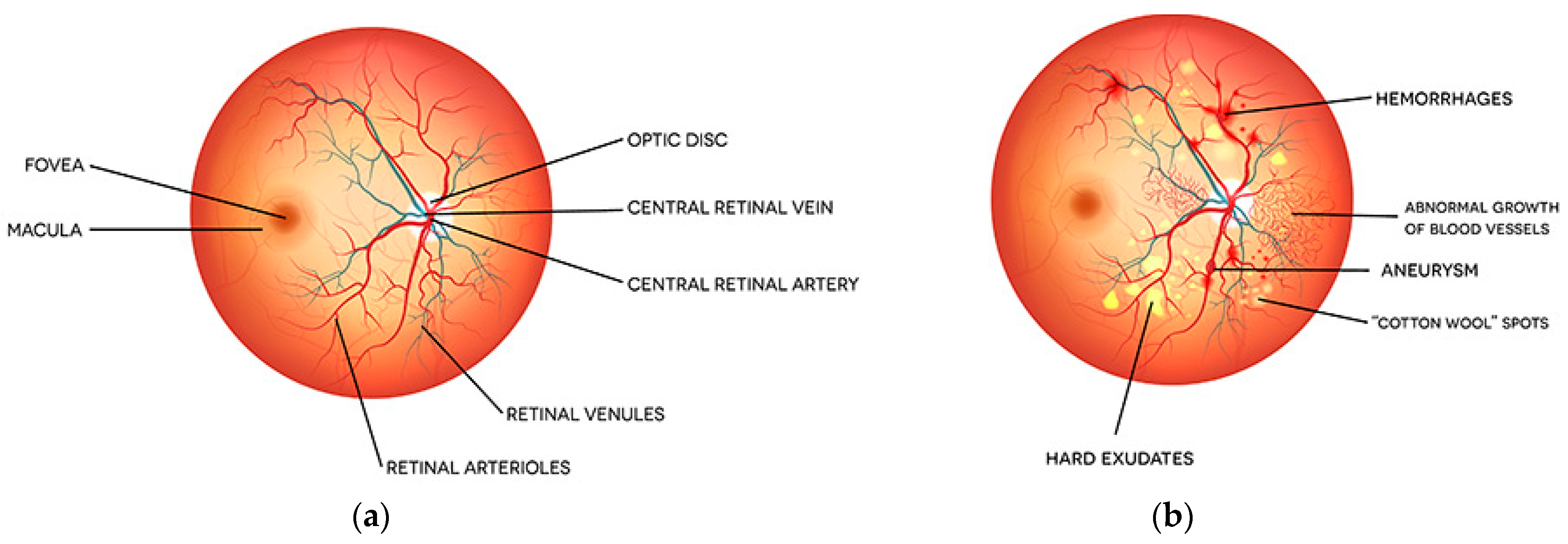 Заболевания глаз при сахарном диабете. Сахарный диабет и зрение. Диабетическая ретинопатия глаз. Изменение органа зрения при сахарном диабете. Зрение при сахарном диабете 2 типа.