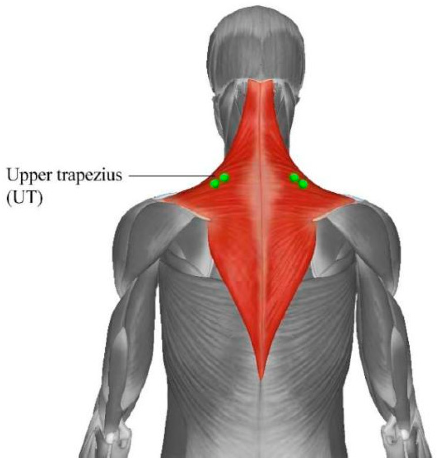 Stretching and Massage Does NOT Get Rid of Upper Trap Pain