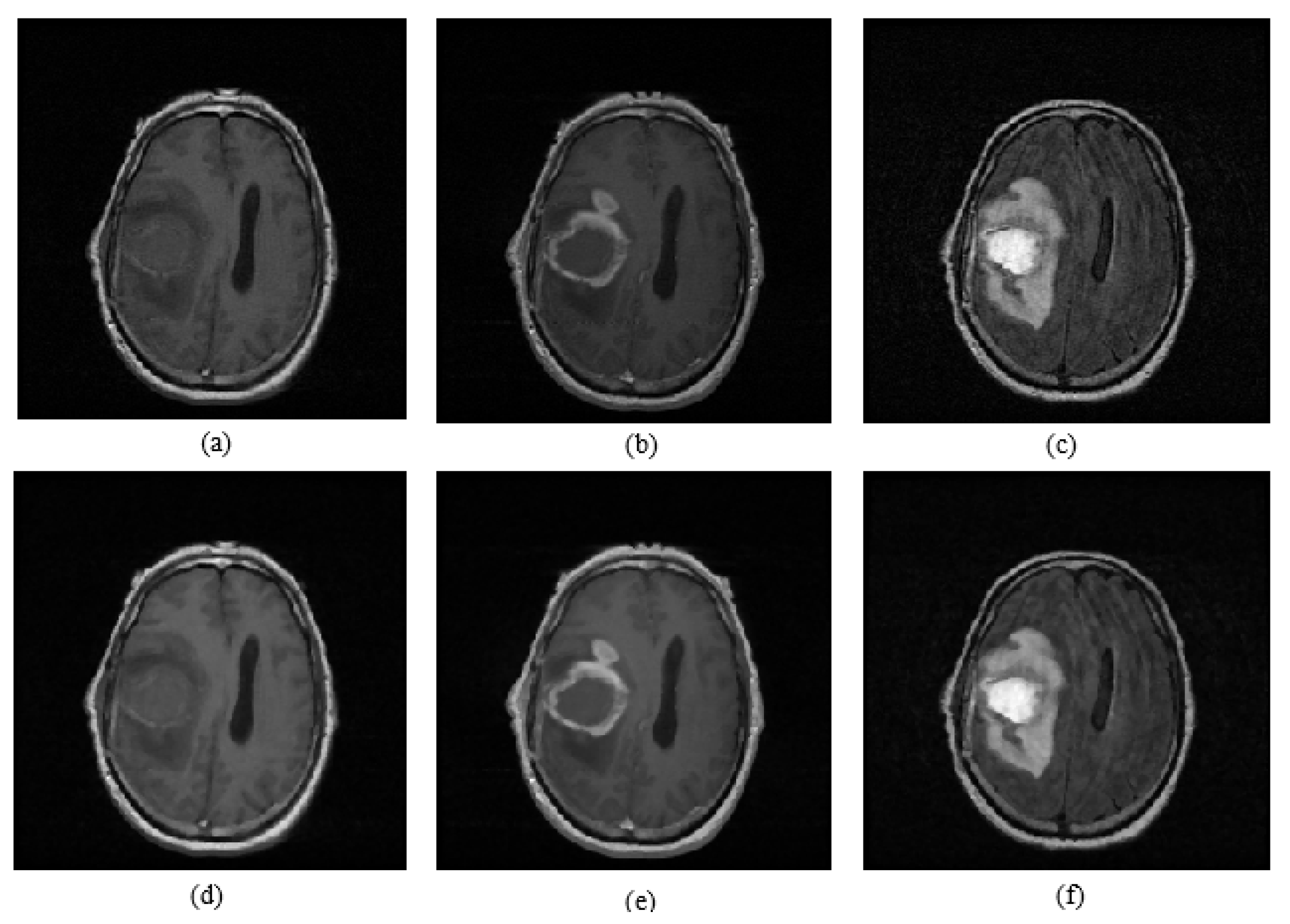 Symmetry free full text automatic brain tumor detection and volume