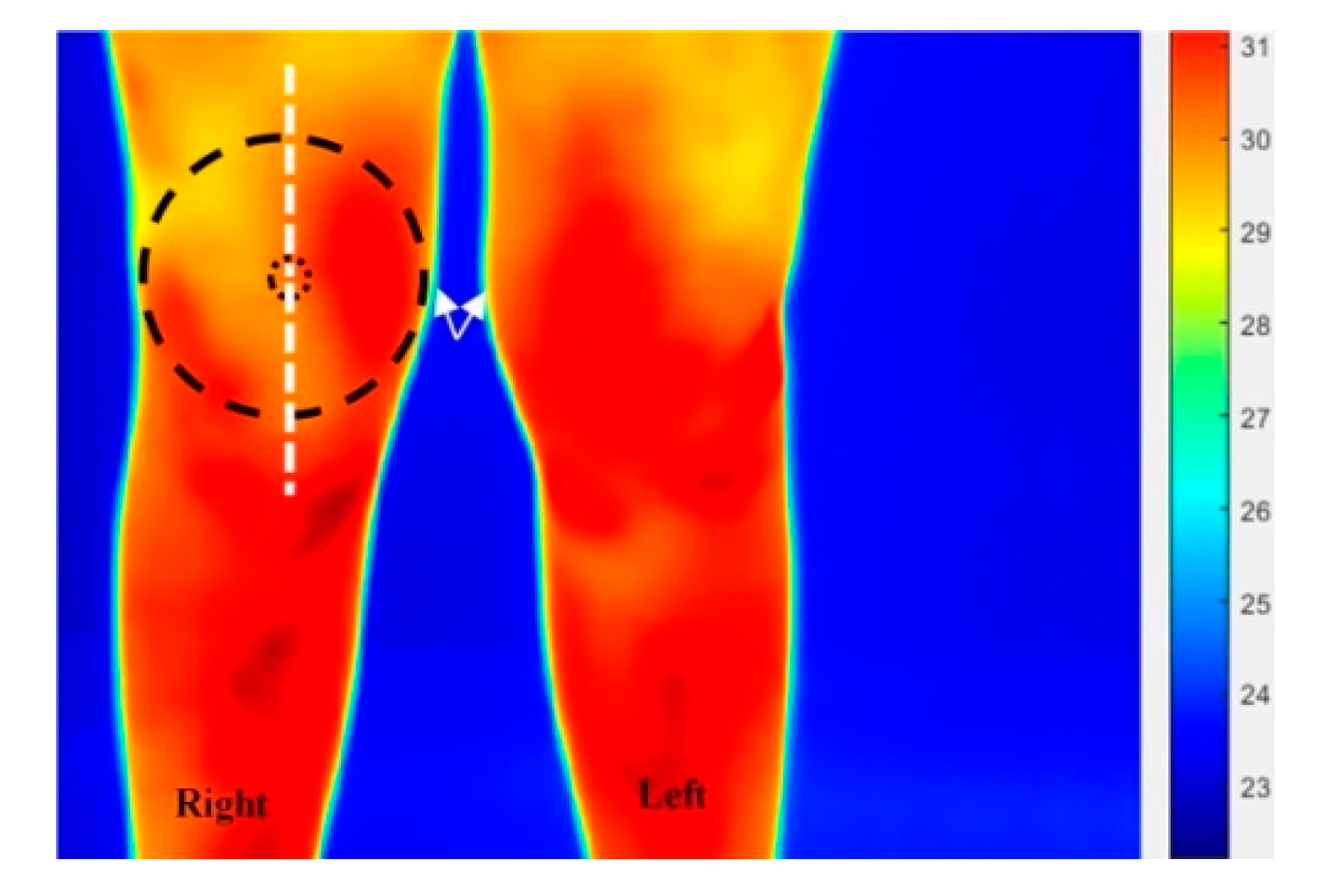Technologies | Free Full-Text | Thermal and Visual Imaging to Assist with Juvenile Idiopathic Arthritis Examination of the Knees | HTML