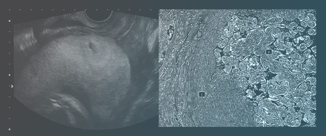 Cesarean-Hysterectomy in Abnormally Invasive Placenta
