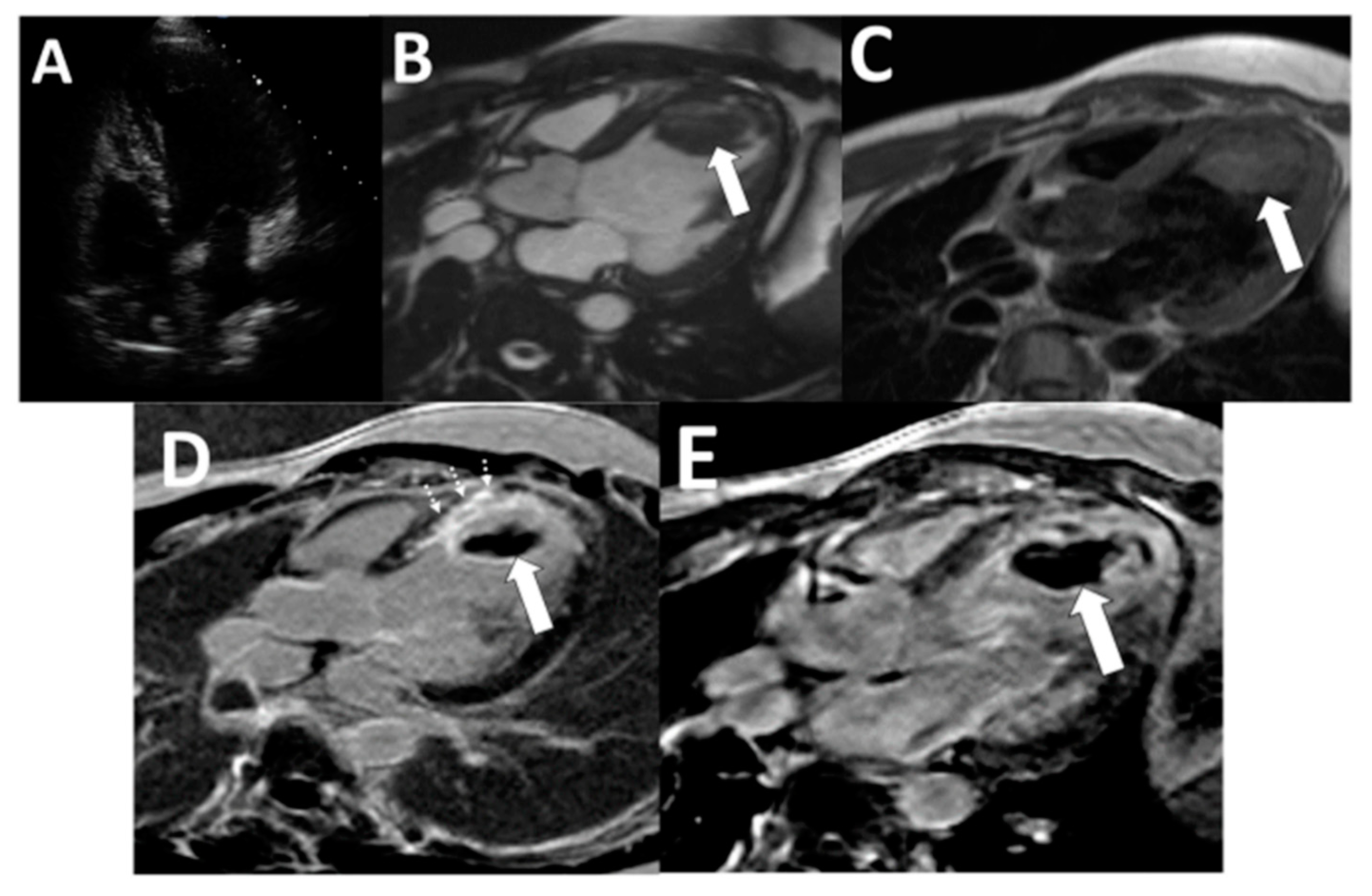 End Børns dag Overleve Tomography | Free Full-Text | Left Ventricular Thrombi: Insights from Cardiac  Magnetic Resonance Imaging
