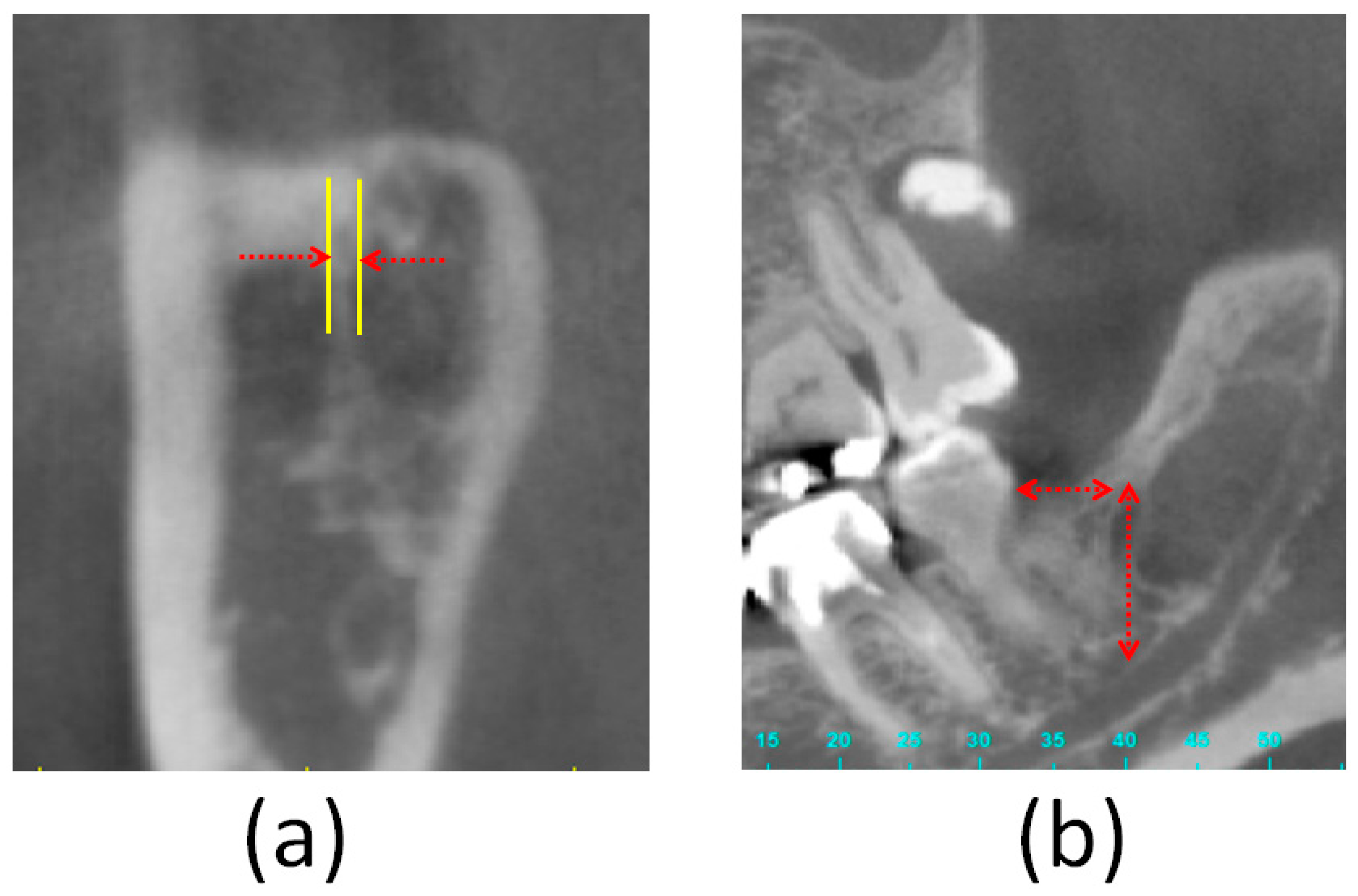 Prevalence of medial depression of the mandibu- lar ramus (MDMR) in the