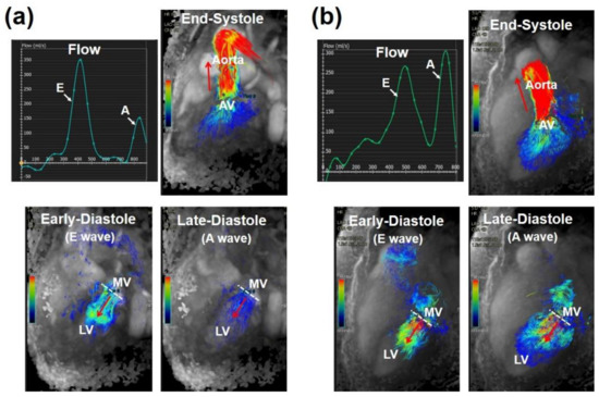 Myocardial Strain Evaluation with Cardiovascular MRI: Physics, Principles,  and Clinical Applications