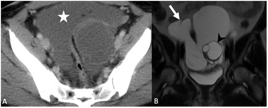 Mimics and Pitfalls of Primary Ovarian Malignancy Imaging