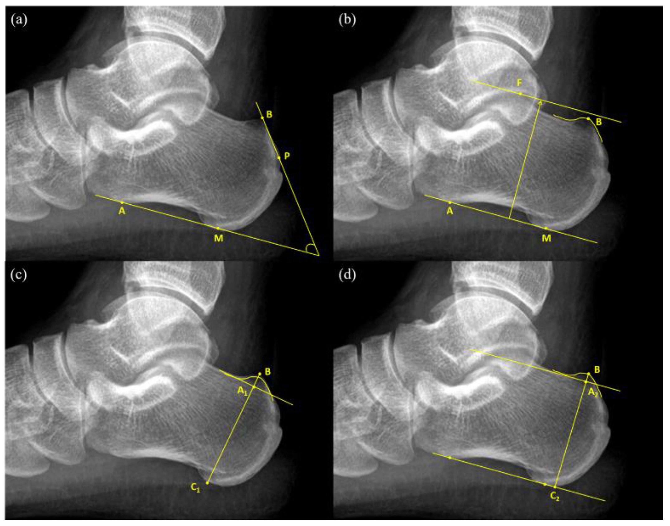 Top 123 Heel Haglund Deformity Best Esthdonghoadian