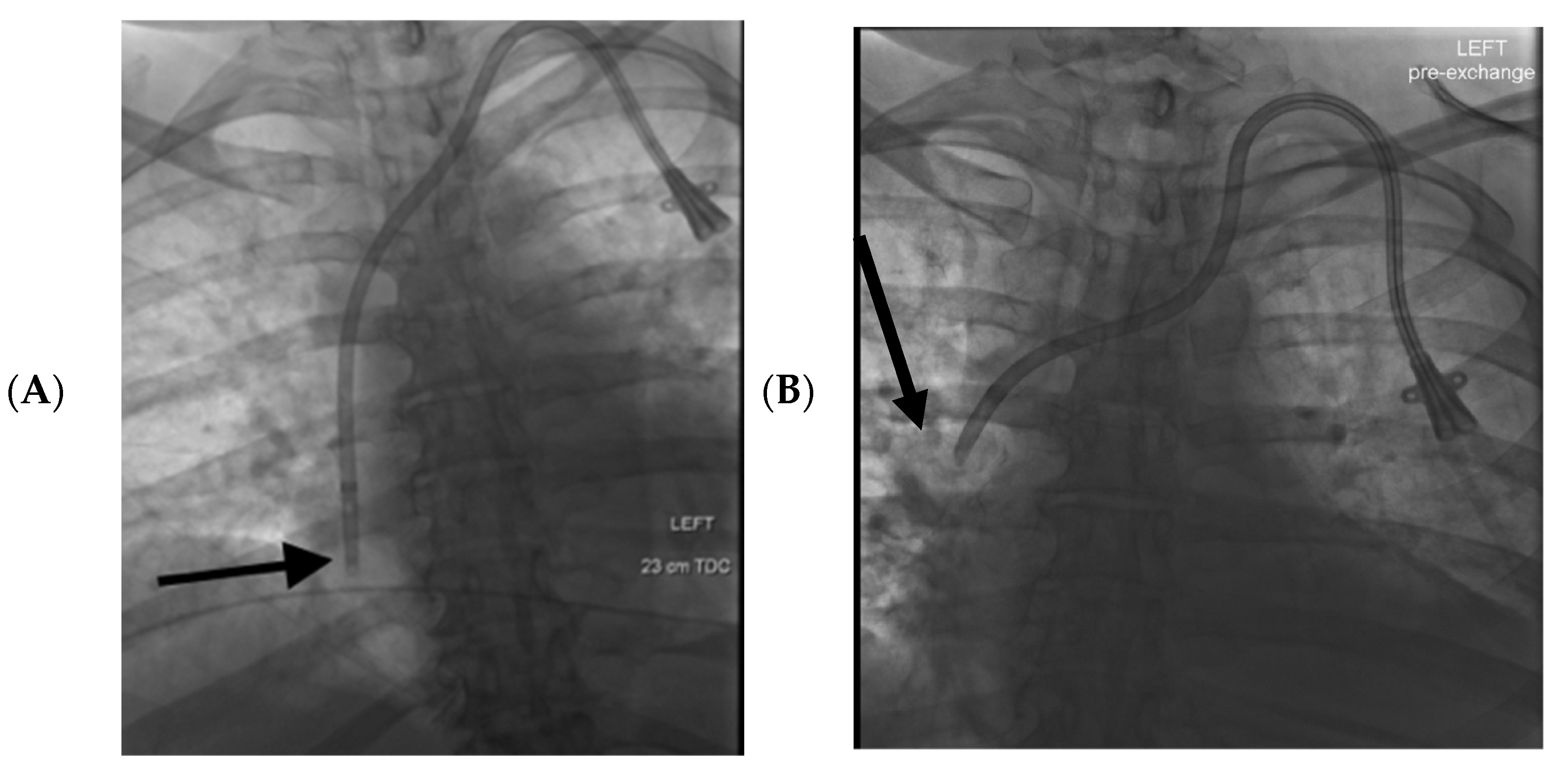 Tomography Free FullText Internal Jugular Central Venous Catheter