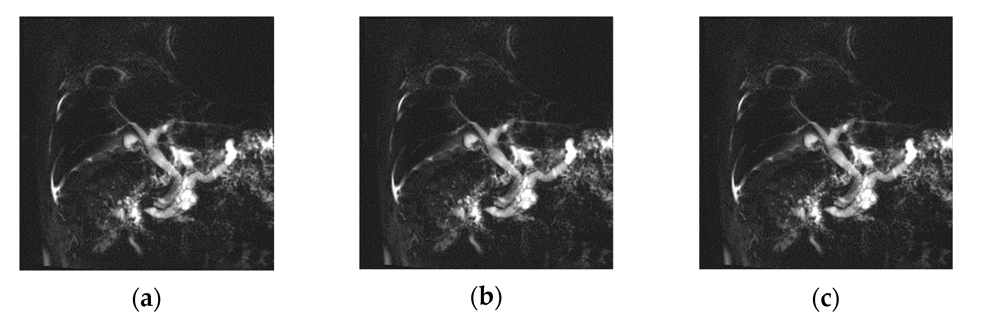 Tomography Free Full Text Evaluating The Quality Of Optimal Mrcp Image Using Rt 2d Compressed Sense Cs Turbo Spin Echo Comparing Respiratory Triggering Rt 2d Sense Turbo Spin Echo And Breath Hold 2d Single Shot Turbo Spin Echo Tomography Free Full Text Evaluating The Quality Of Optimal Mrcp Image Using Rt 2d Compressed Sense Cs Turbo Spin Echo Comparing Respiratory Triggering Rt 2d Sense Turbo Spin Echo And Breath Hold 2d Single Shot Turbo Spin Echo