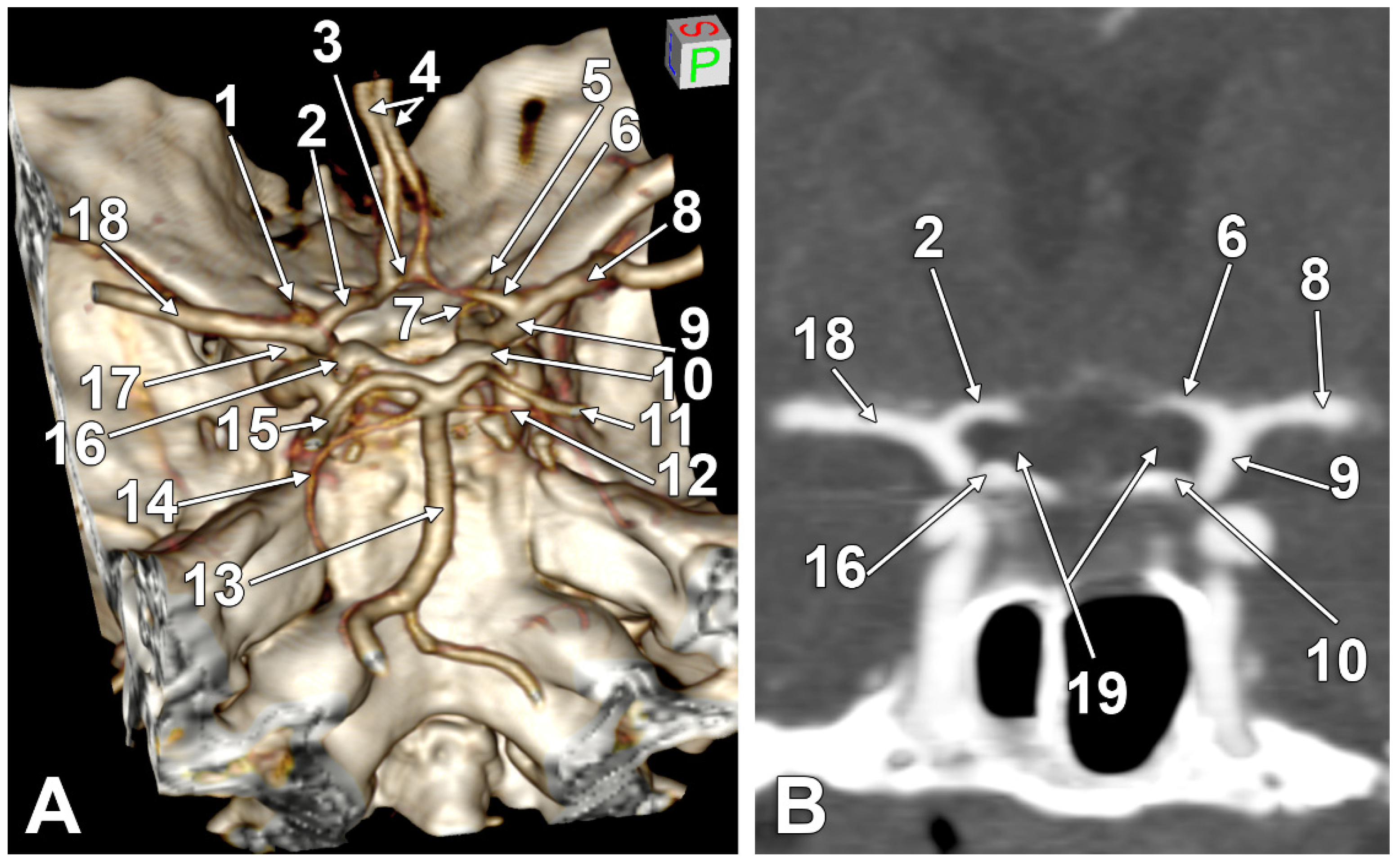 The Infraoptic or Infrachiasmatic Course of the Anterior