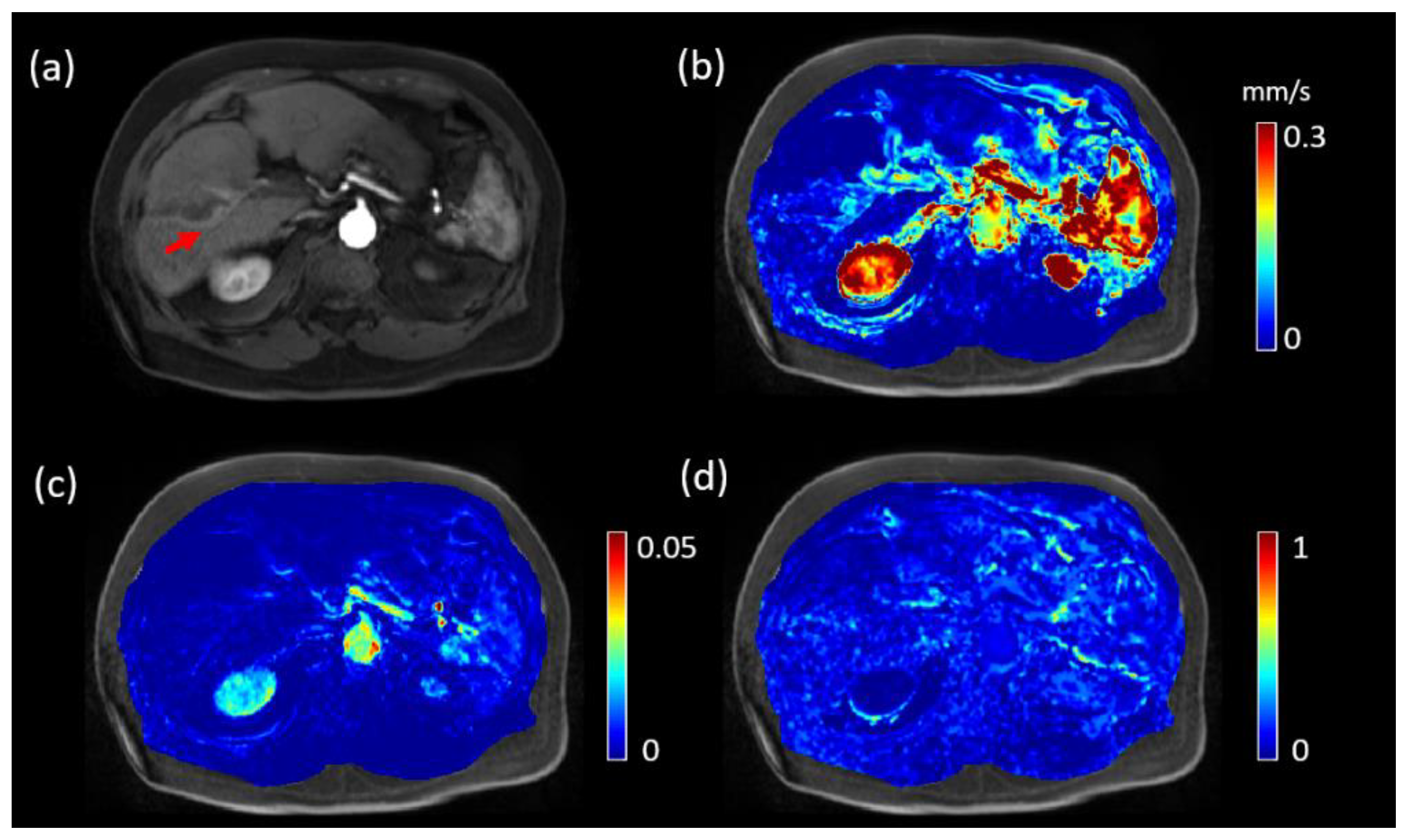 Swipe spion sydvest Tomography | Free Full-Text | Prediction of Lung Shunt Fraction for  Yttrium-90 Treatment of Hepatic Tumors Using Dynamic Contrast Enhanced MRI  with Quantitative Perfusion Processing