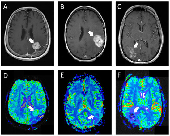 Perfusion-Weighted Imaging: The Use of a Novel Perfusion