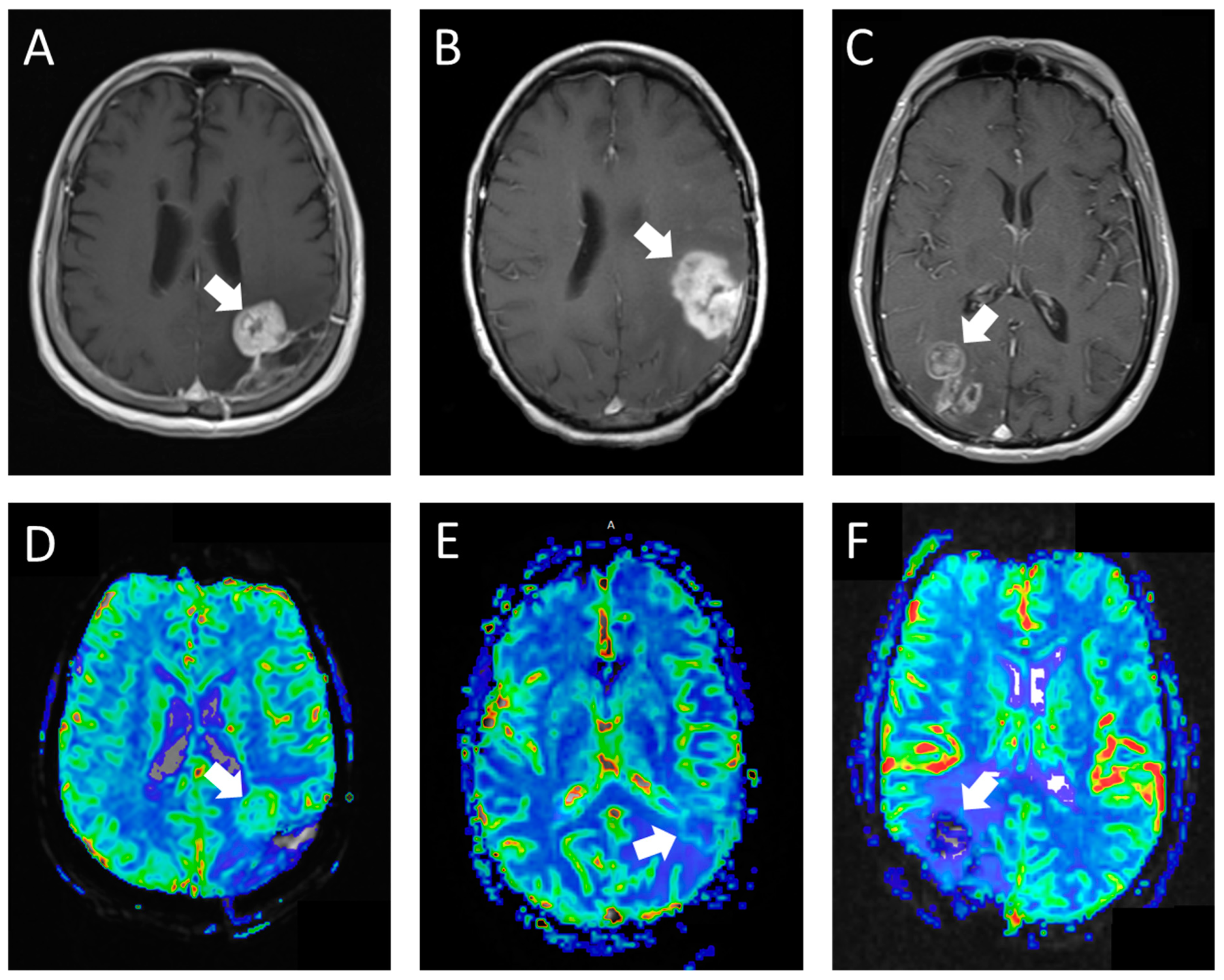 Automated MRI perfusion-diffusion mismatch estimation may be