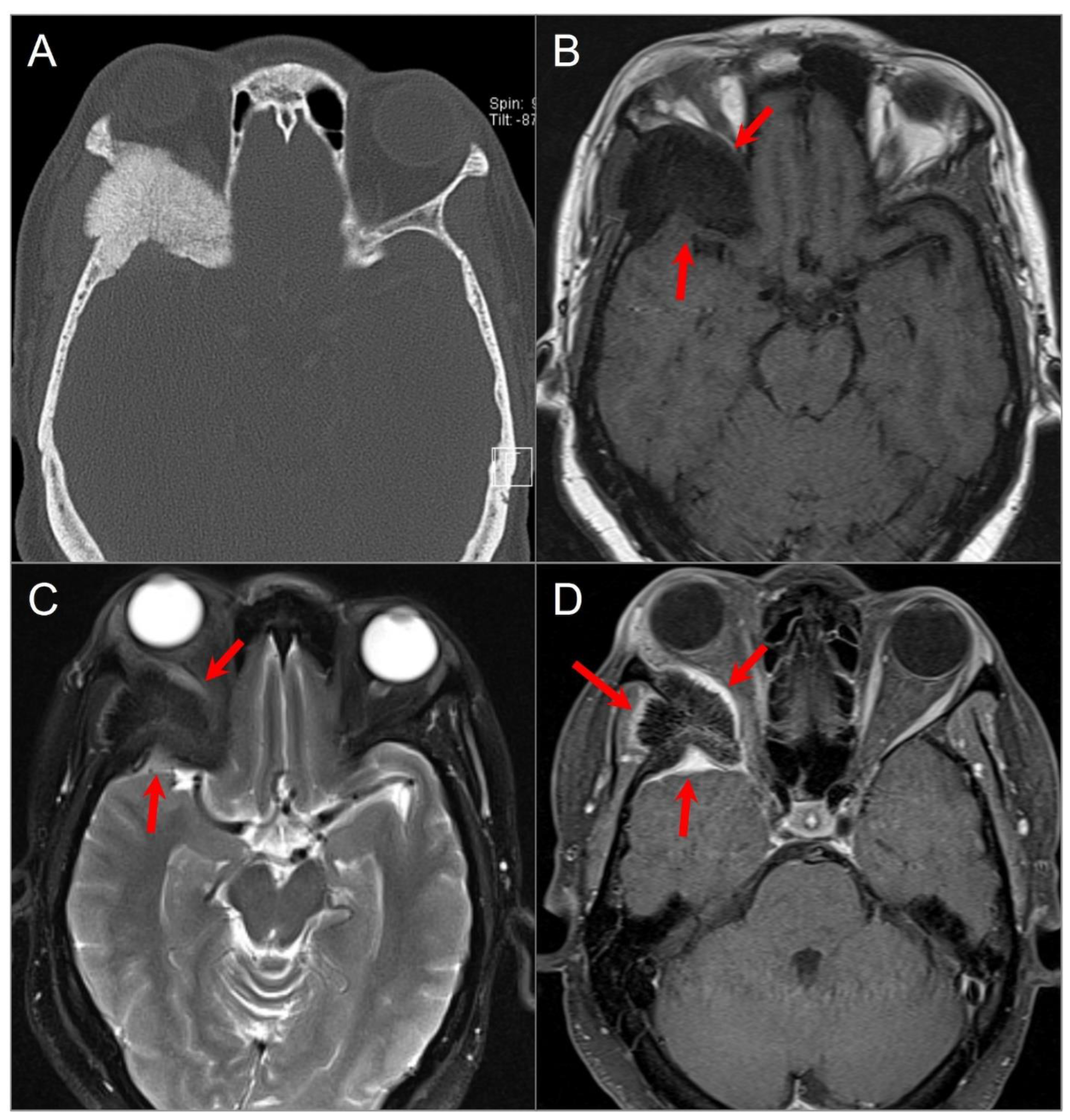 Imaging of Skull Base Tumors