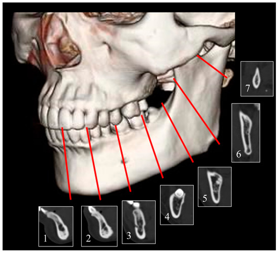 Mandible