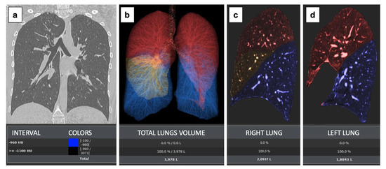 Long COVID in Young Patients: Impact on Lung Volume Evaluated