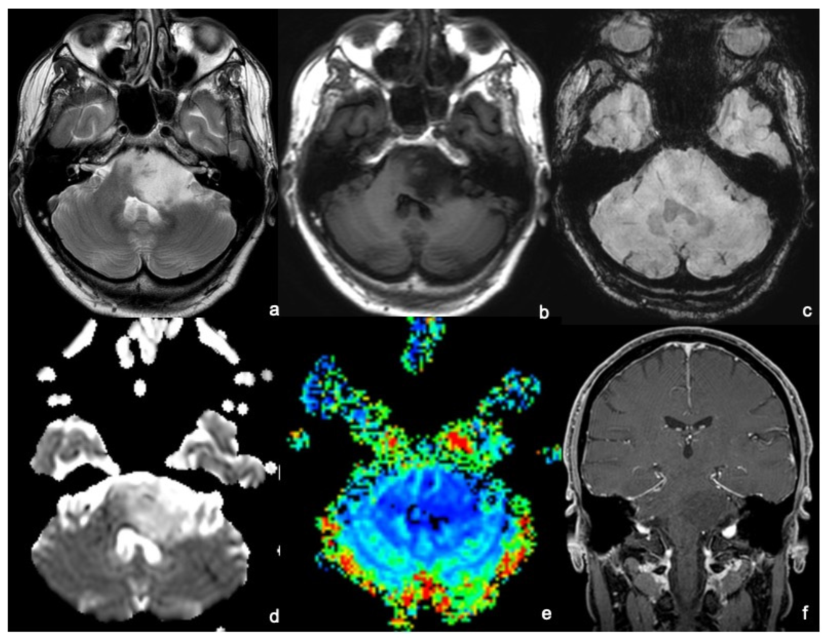 Serial cerebral magnetic resonance (MR) images demonstrate lesion... |  Download Scientific Diagram