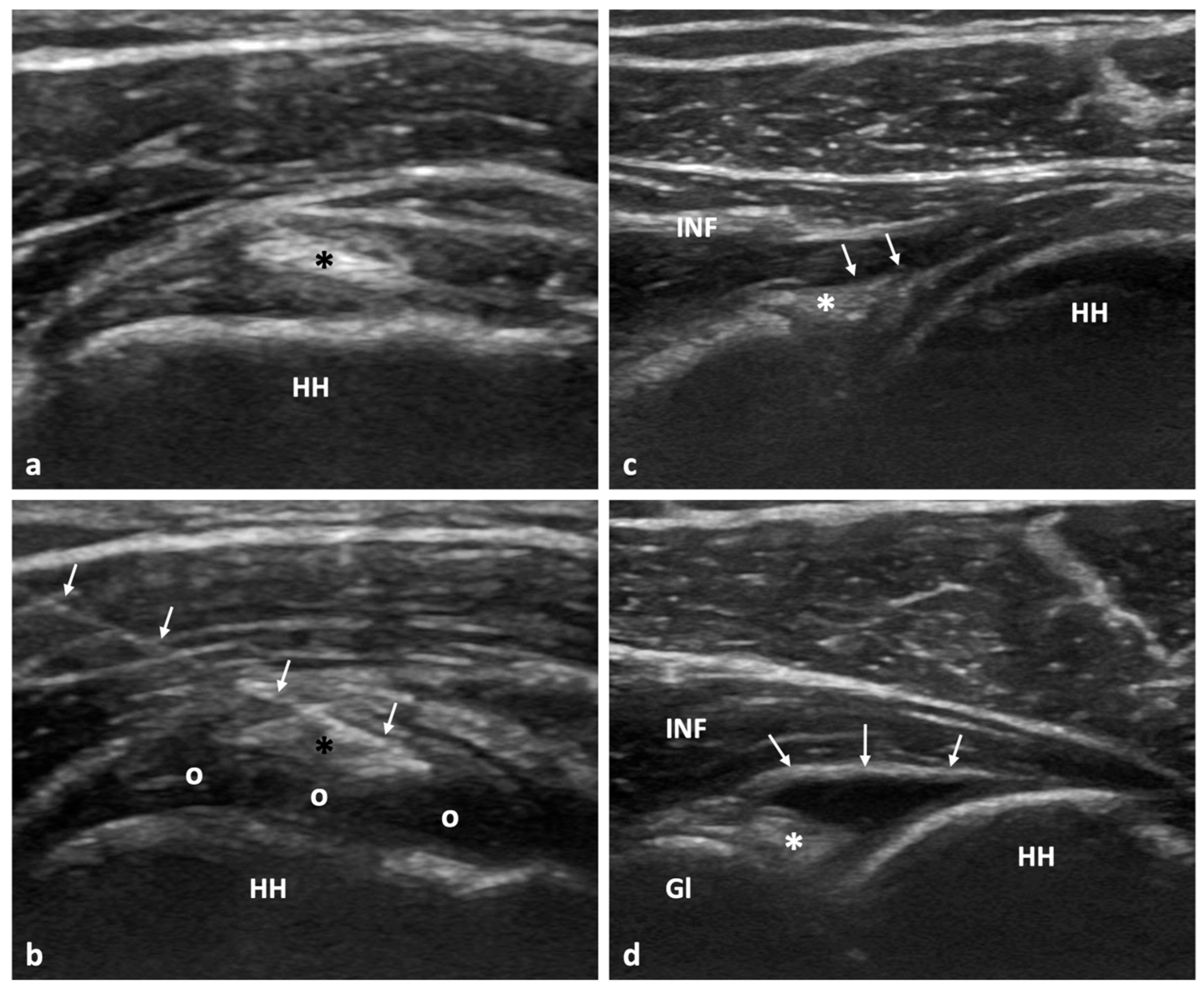 Tomography Free FullText LongTerm of UltrasoundGuided Hydrodistension for