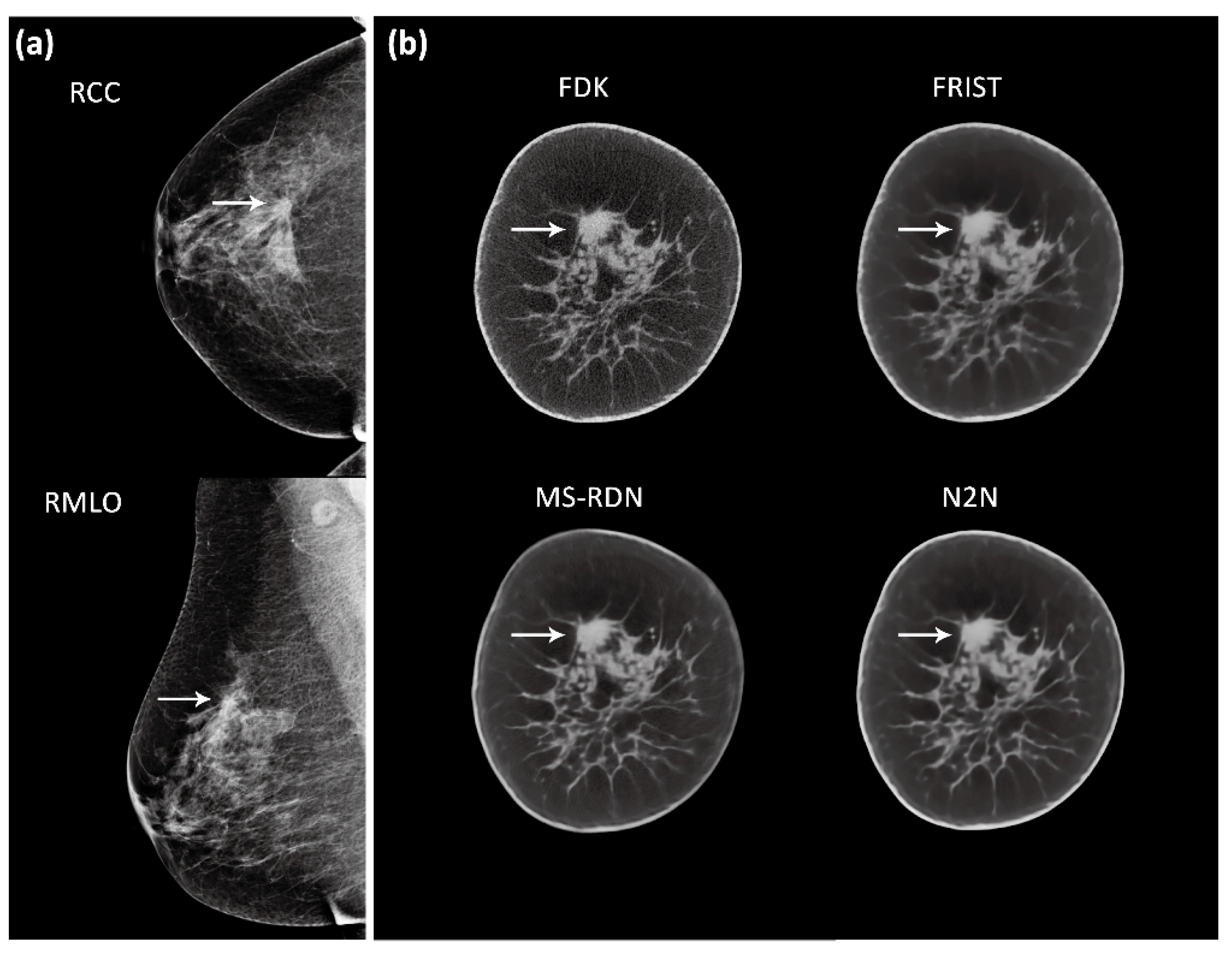 Frontiers  Cone-beam breast CT-guided surface location facilitates breast-conserving  surgery in breast cancer patients with extensive calcifications: A pilot  study