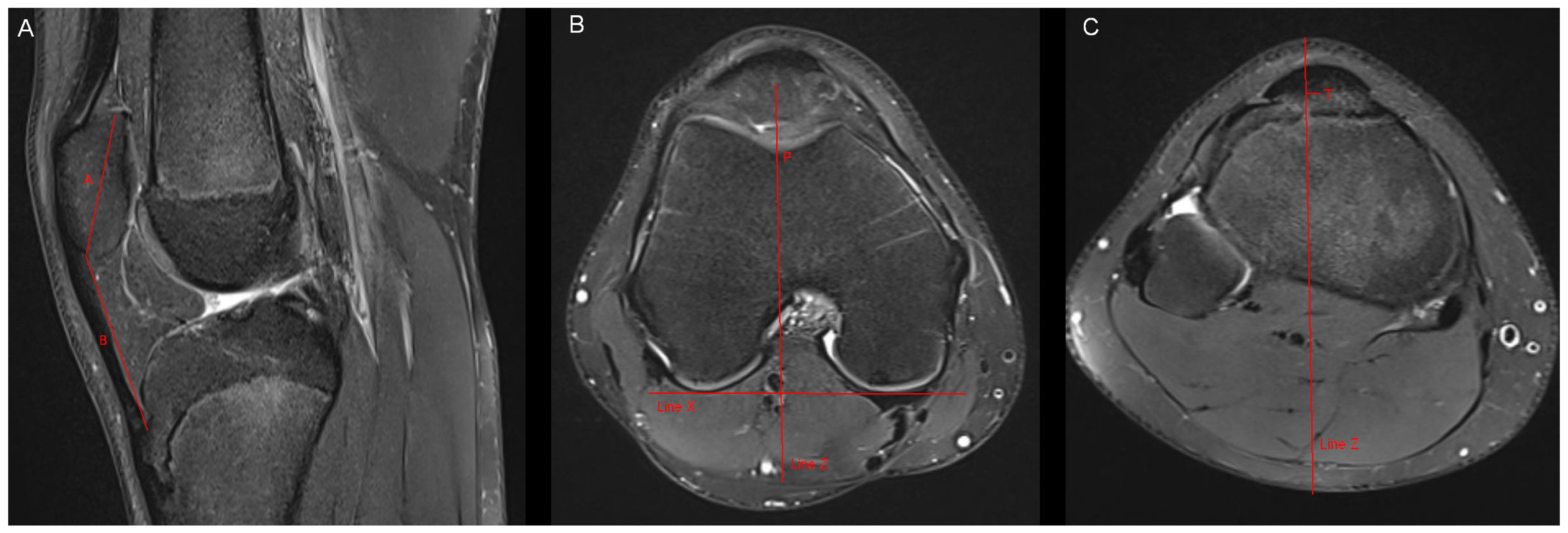 Mri, Arthroscopy, and Surgical Anatomy of the Joints