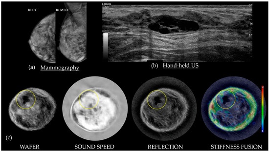 Breast Tomographic Ultrasound: The Spectrum from Current Dense