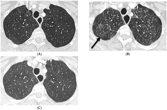 Uncommon Causes of Interlobular Septal Thickening on CT Images and Their  Distinguishing Features