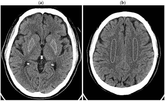 Noise Reduction in Brain CT: A Comparative Study of Deep