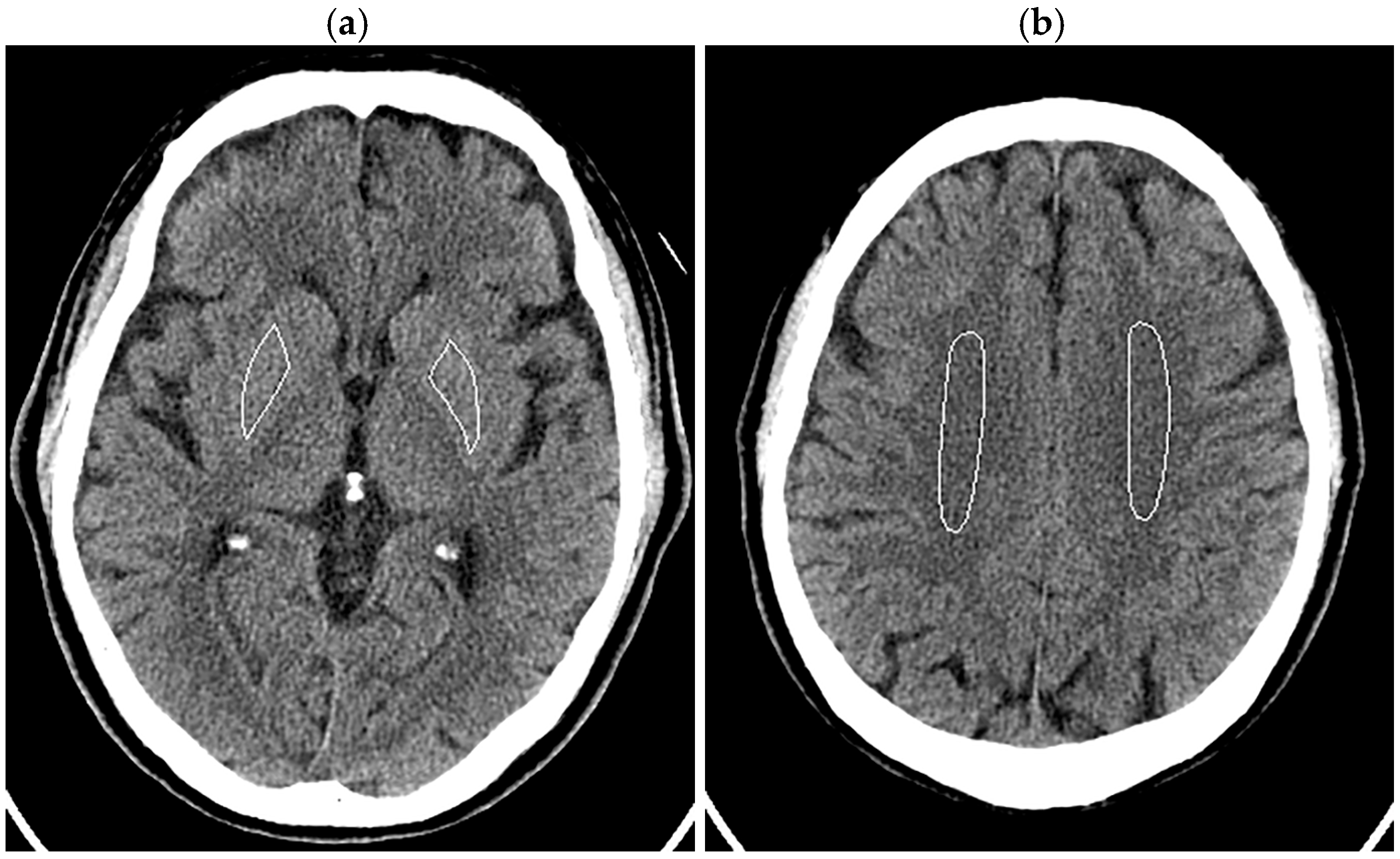 Noise Reduction in Brain CT: A Comparative Study of Deep