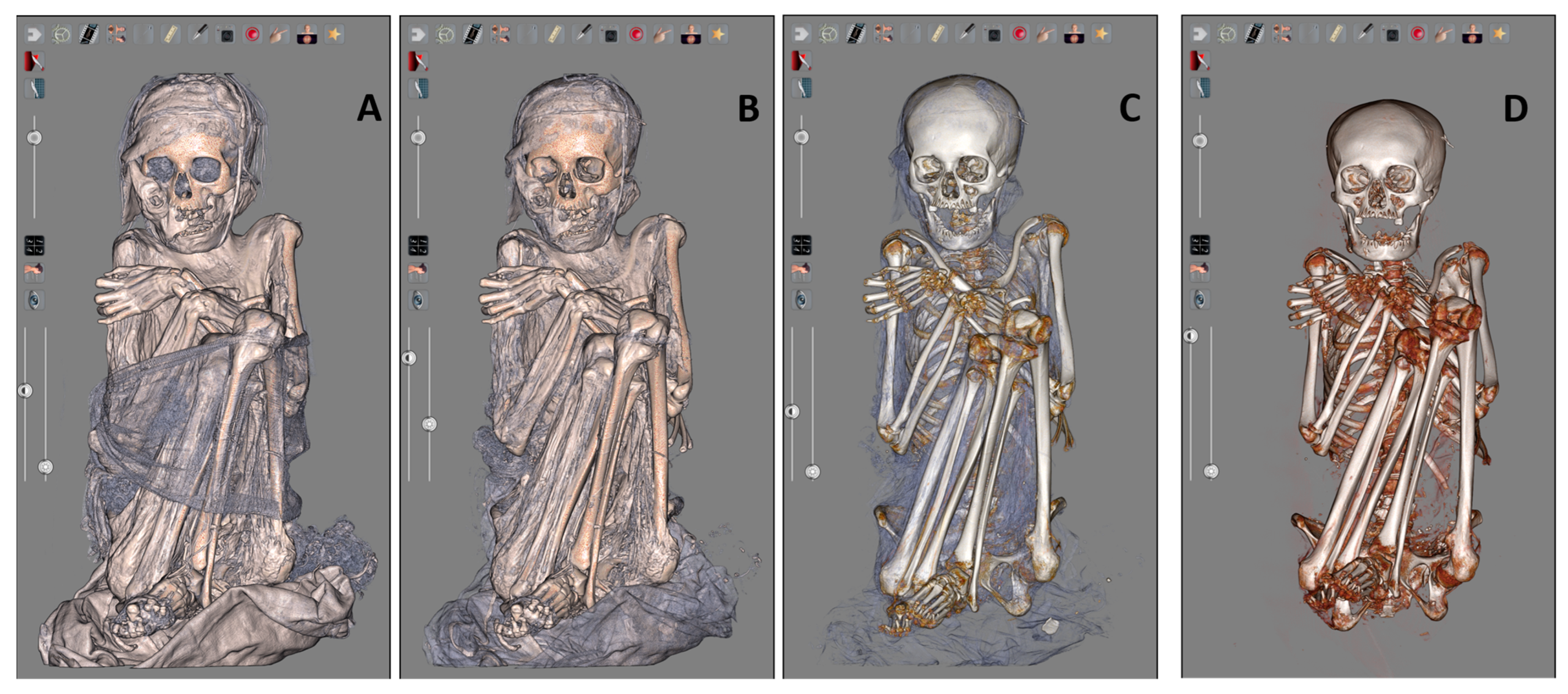 Tomography 11 00005 g006