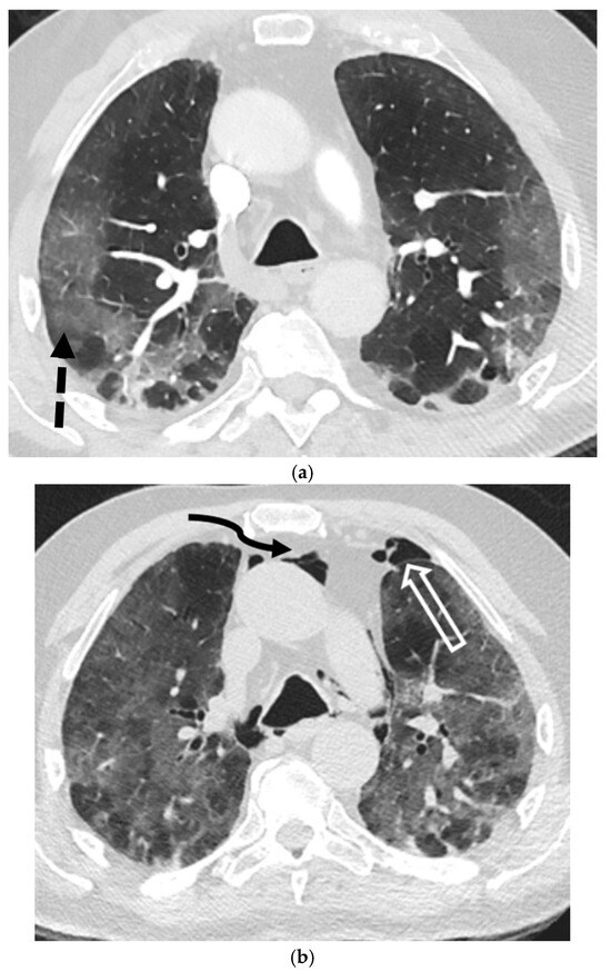 Spontaneous Pneumothorax: A Review of Underlying Etiologies and Diagnostic  Imaging Modalities