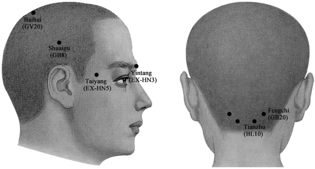 Botox Injection Sites For Migraines Diagram - Free Wiring Diagram