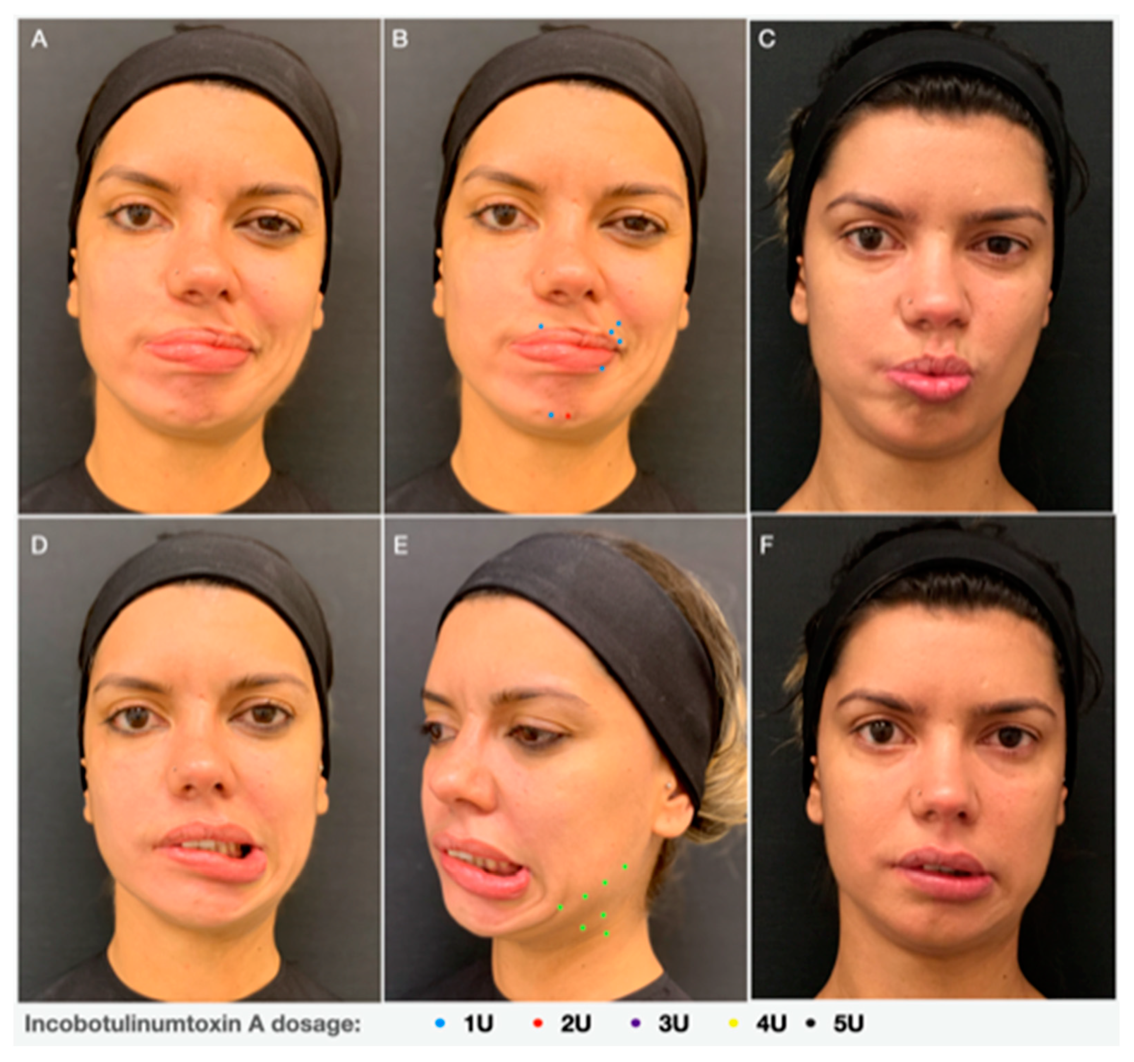 Toxins Free Full Text Botulinum Toxin Type A To Improve Facial Symmetry In Facial Palsy A Practical Guideline And Clinical Experience Html