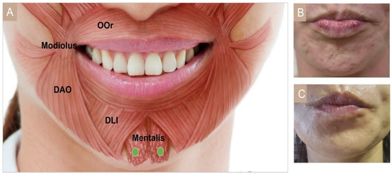 Cosmetic Treatment Using Botulinum Toxin in the Oral and