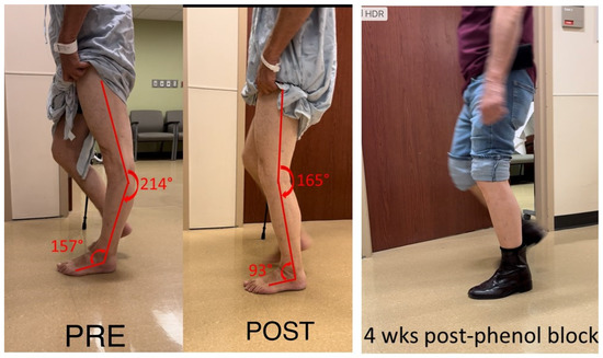 Hip Knee Hyperextension hip-knee-hyperextension