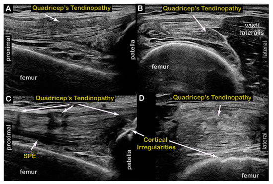 The Relationship Between Stiff Knee Gait Runner's Dystonia