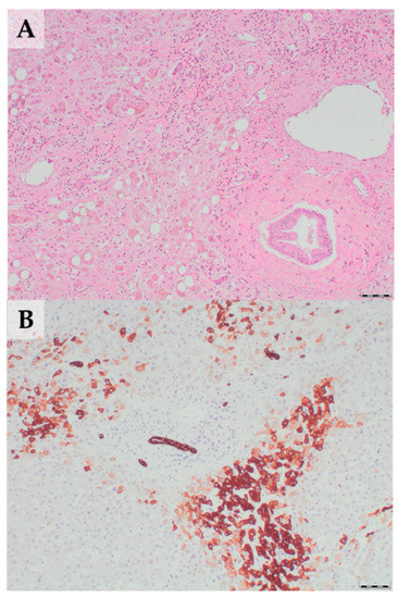 Transplantology | Free Full-Text | Chronic Antibody-Mediated Liver