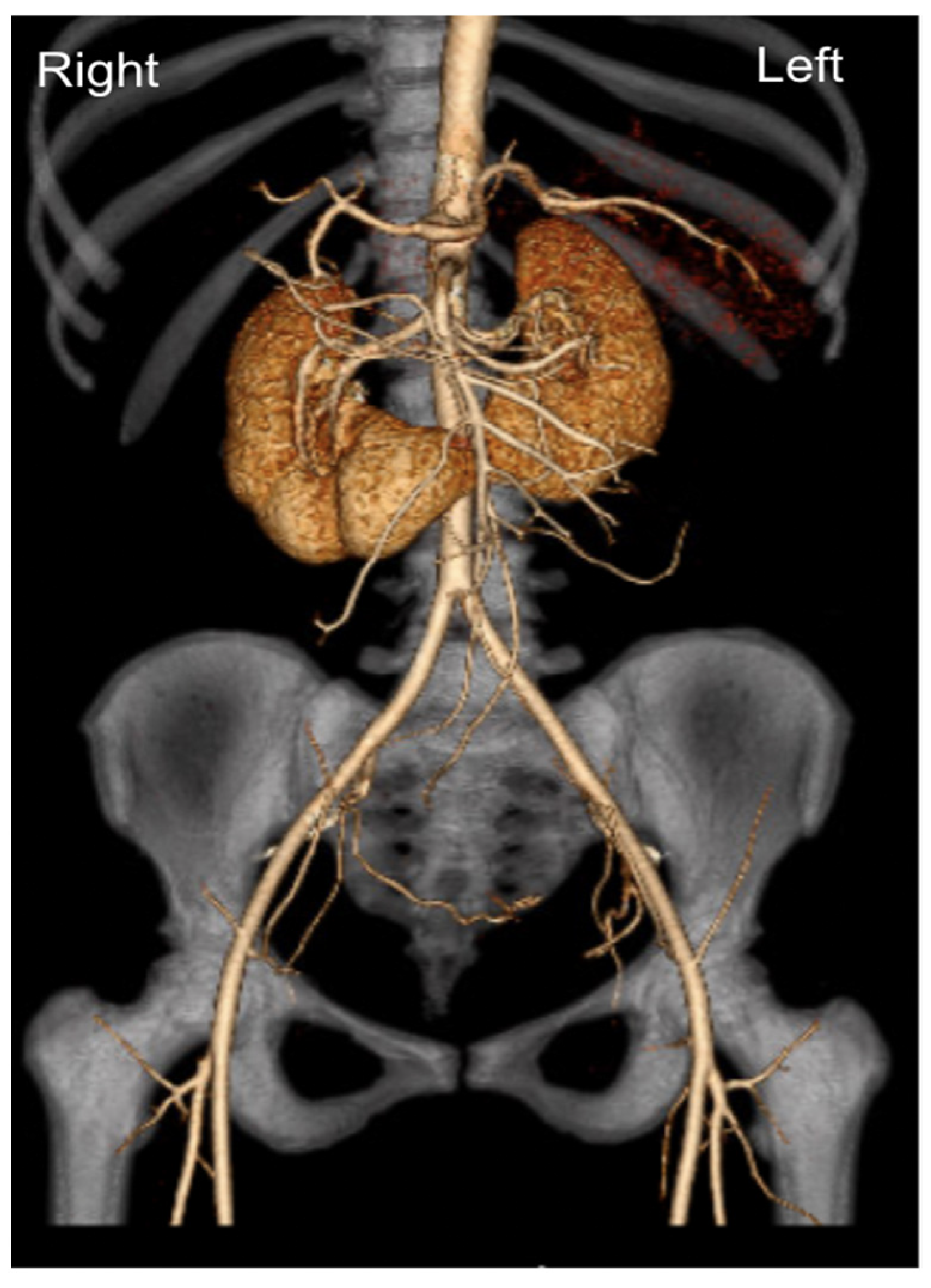 Transplantology Free FullText Laparoscopic LivingDonor