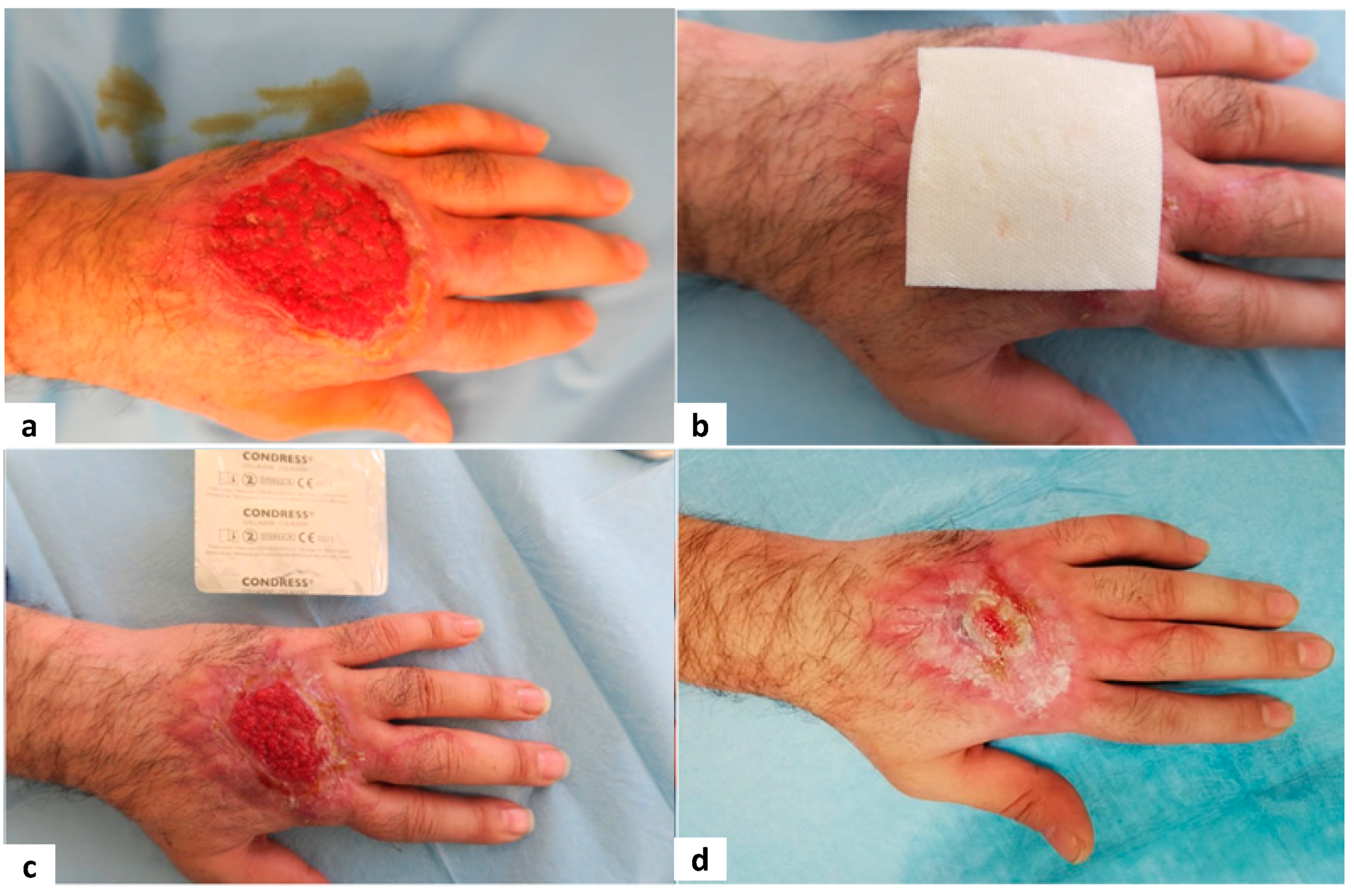 Trauma Care | Free Full-Text | Safety and Efficacy of Collagen-Based  Biological Dressings in the Management of Chronic Superficial Skin Wounds  in Non-Complex Trauma: A Post-Marketing Surveillance Study