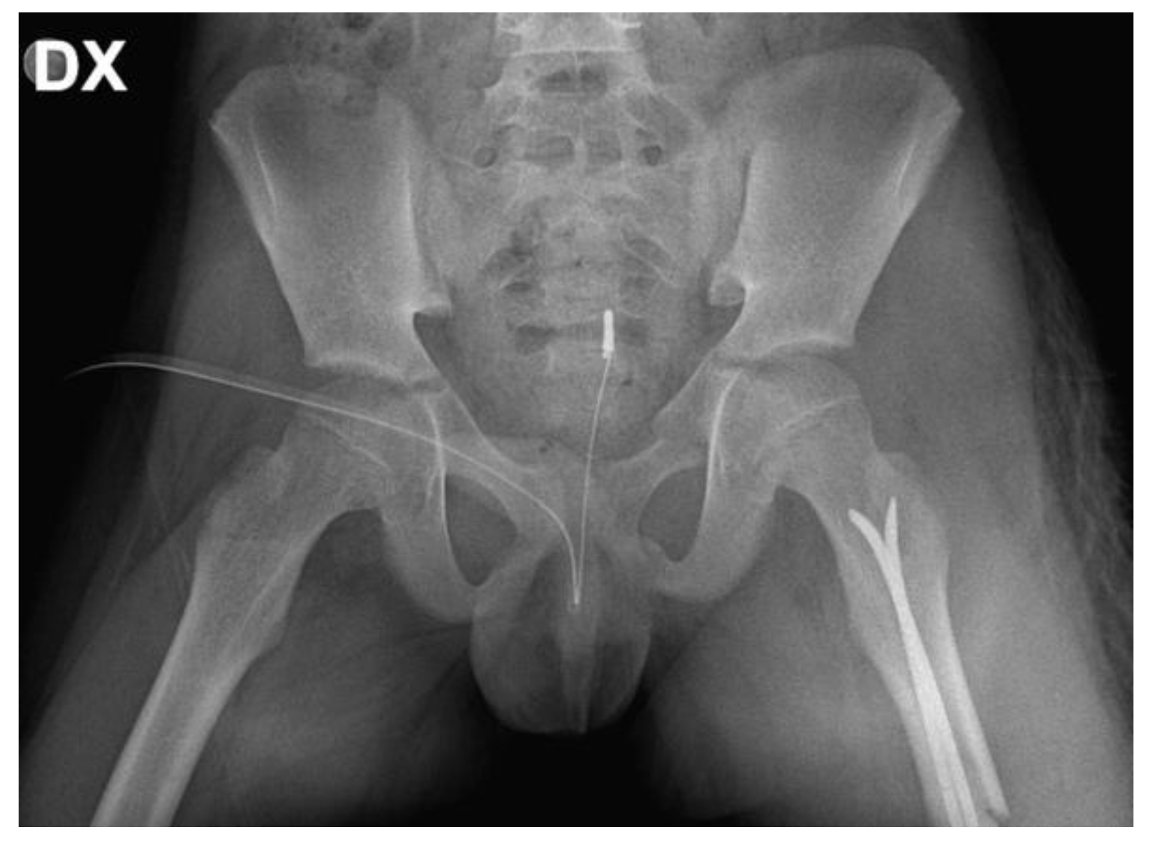 Assessing & Treating Pelvic Injuries in the Field